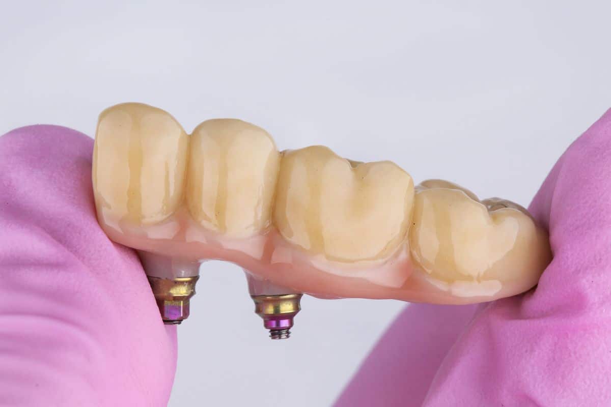 Benefits of Dental Bridges