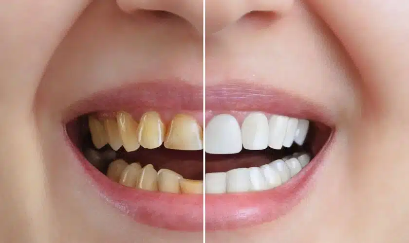 Brighten Your Smile: Restore Yellow Teeth!