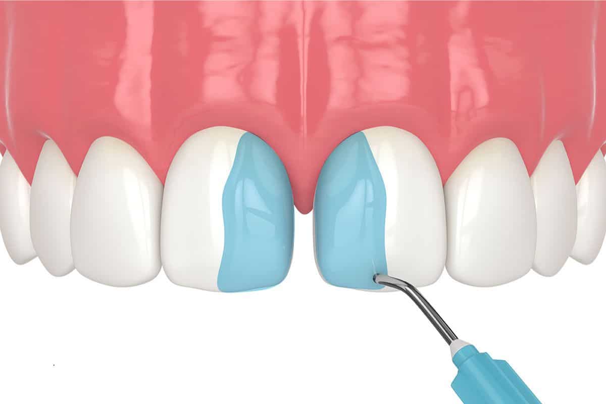 How Many Teeth Can You Fix with Composite Bonding