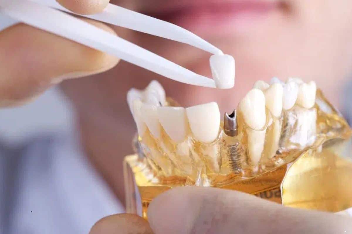 Choosing Dental Implants for a Lasting Smile