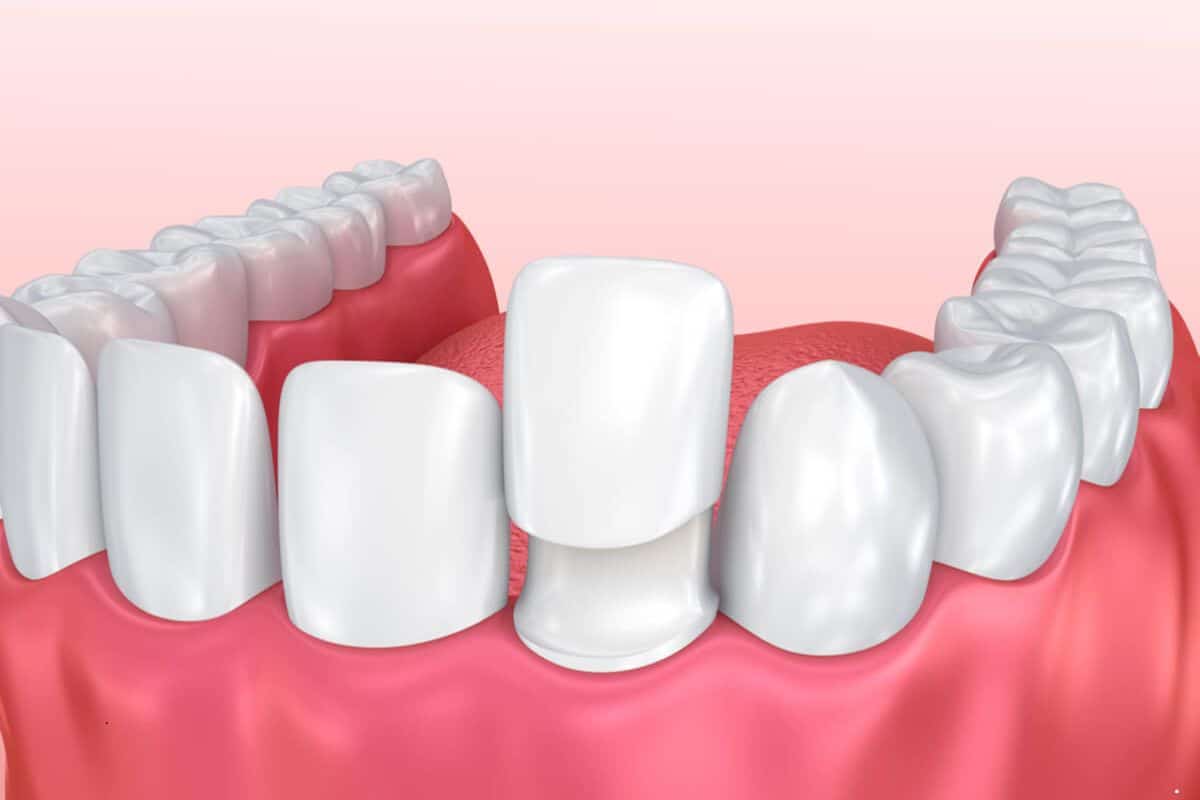 Dental Veneers Can Instantly Transform Your Smile