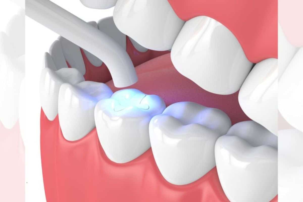 Fixing Tooth Gaps with Dental Bonding